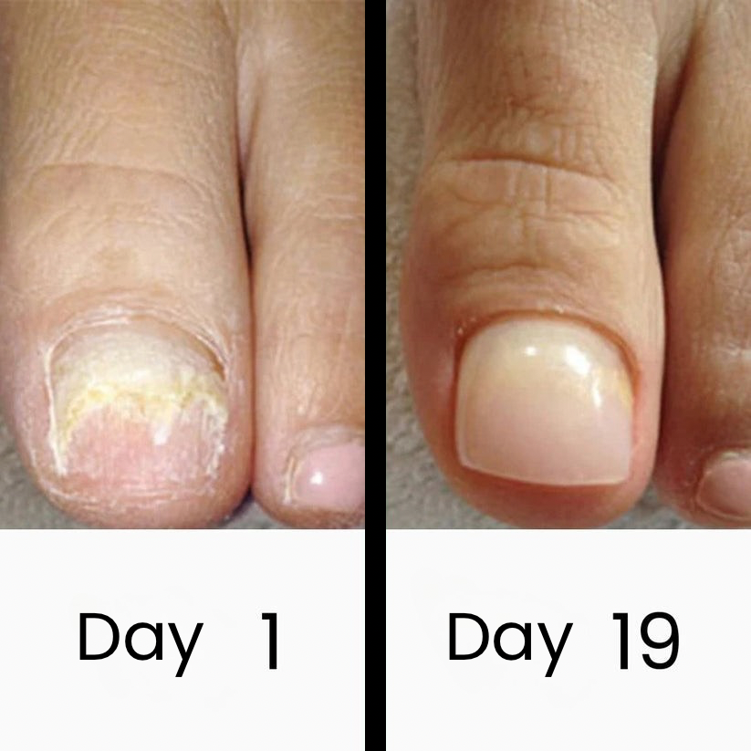 ClearNail Pro™