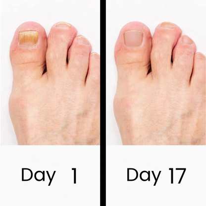 ClearNail Pro™
