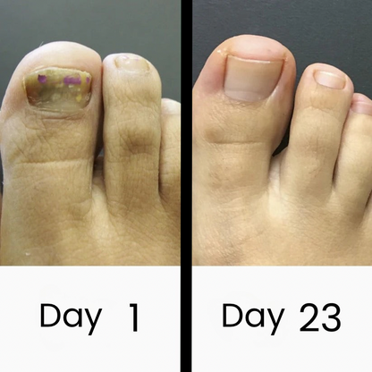 ClearNail Pro™