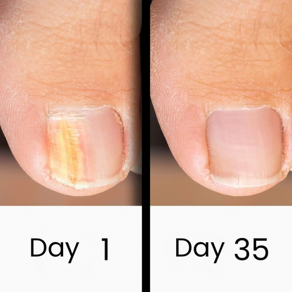 ClearNail Pro™